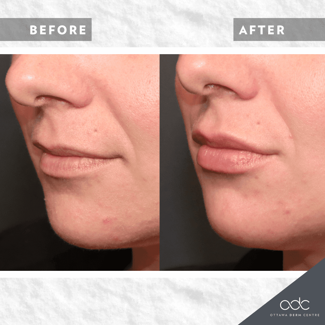 Dermal Fillers Injectable Facial Fillers Skin Fillers