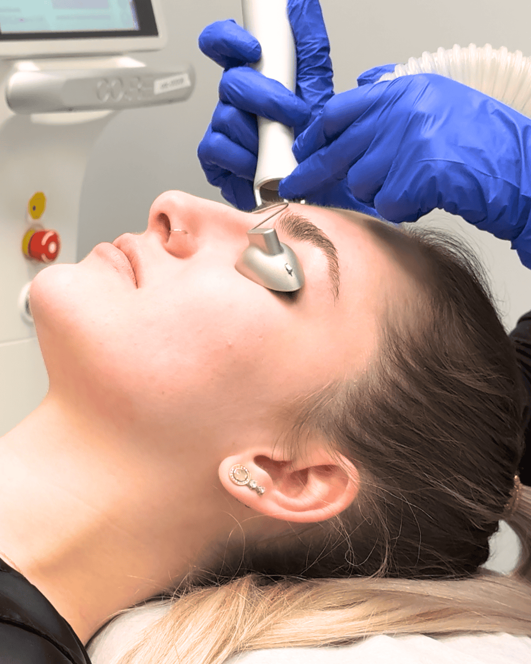 ODC Website Popular Treatment Erbium Resurfacing
