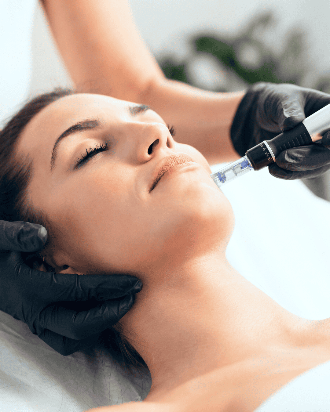 ODC Website Popular Treatment Microneedling
