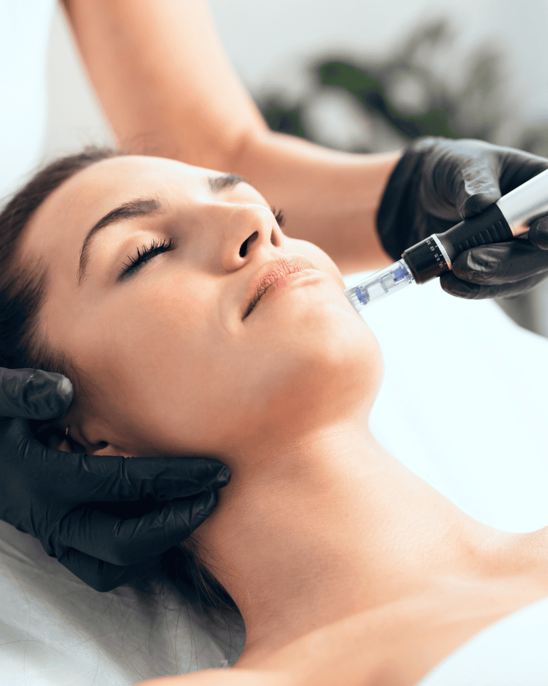 Ottawa Derm Surgery Centre Cosmetic Dermatology Microneedling