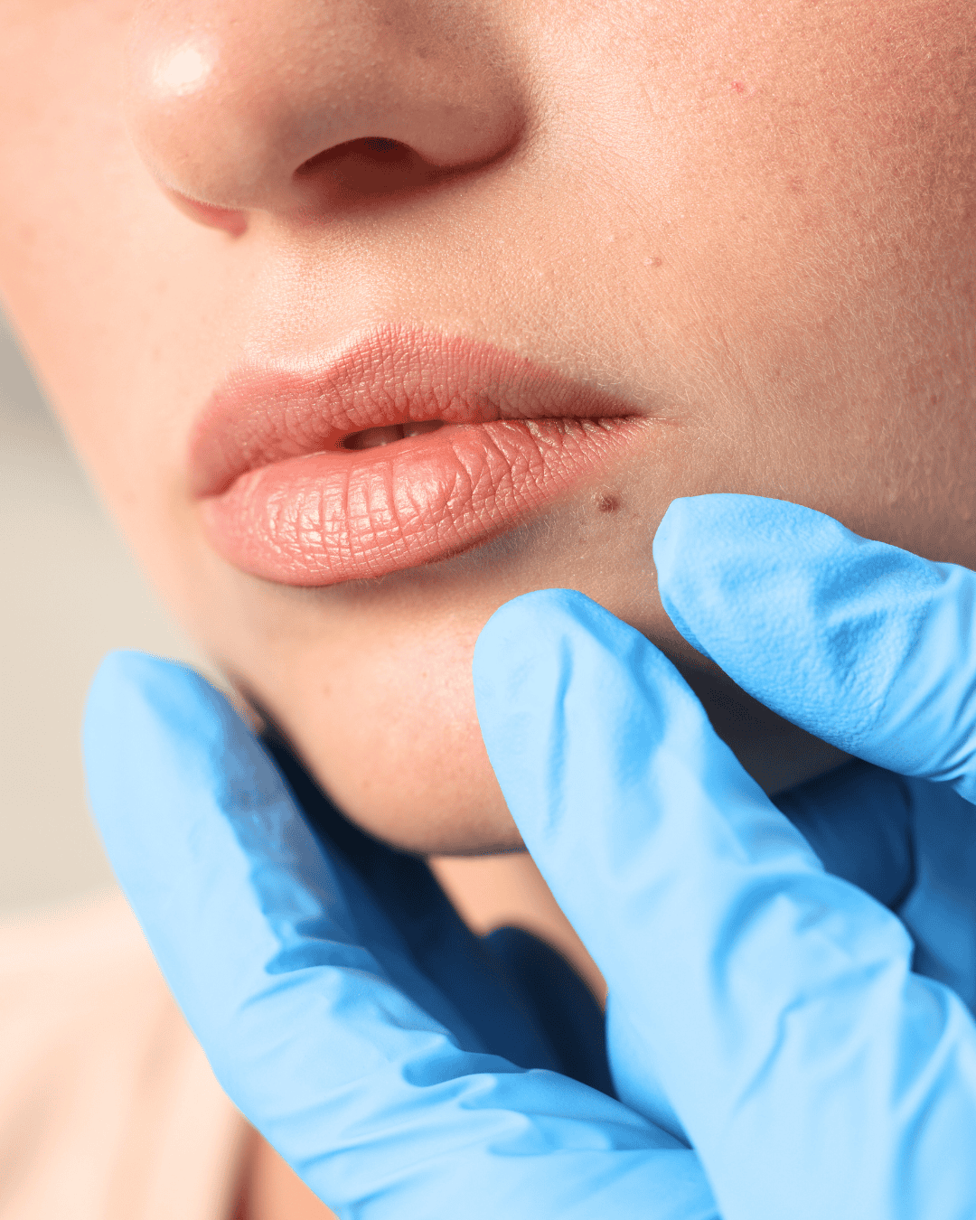Ottawa Derm Surgery Centre Cosmetic Dermatology Mole Removal