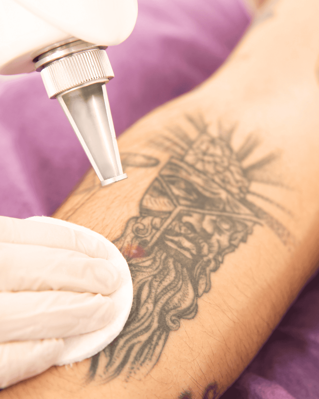 Ottawa Derm Surgery Centre Cosmetic Dermatology Tattoo Removal
