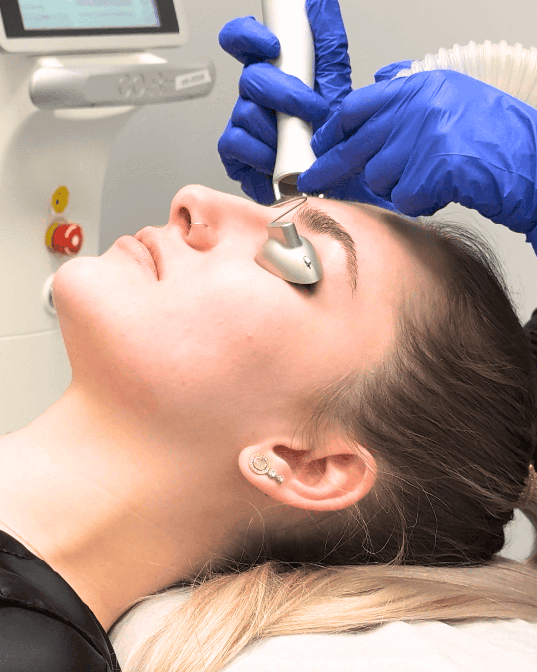 Ottawa Derm Surgery Centre Cosmetic Treatments CO2 Skin Resurfacing