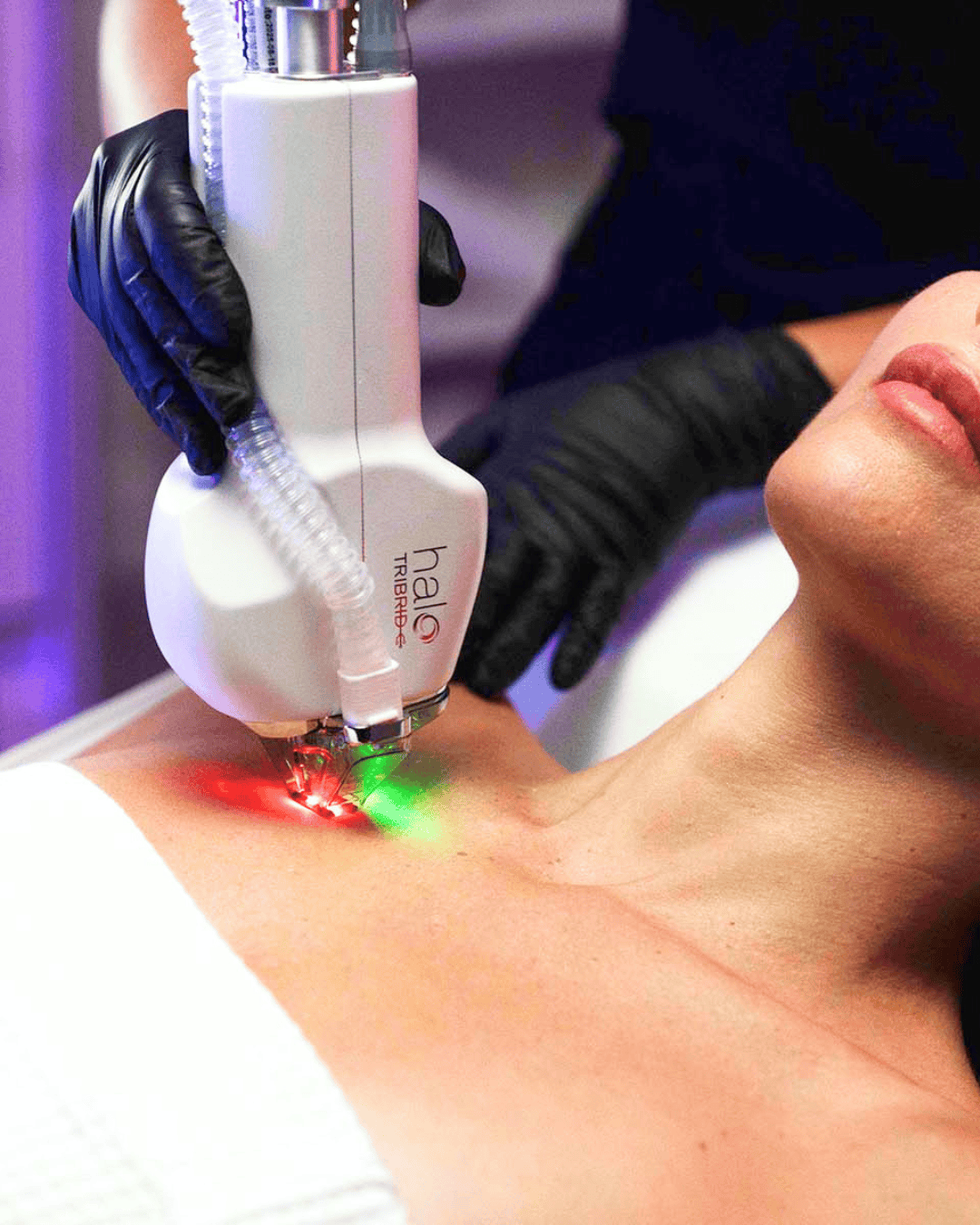 Ottawa Derm Surgery Centre Cosmetic Treatments HALO TRIBRID
