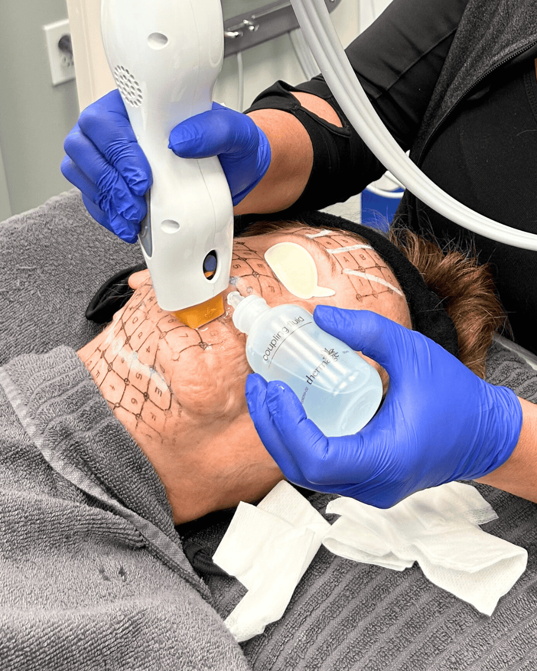Ottawa Derm Surgery Centre Cosmetic Treatments Thermage