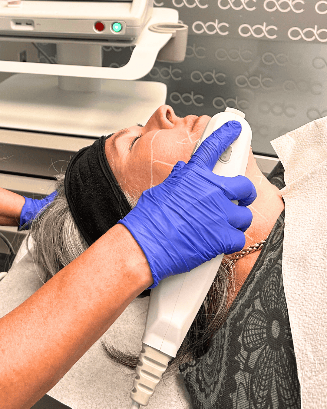 Ottawa Derm Surgery Centre Cosmetic Treatments Ultherapy