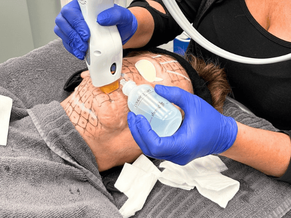 Ottawa Derm Surgery Centre Thermage Special Offers